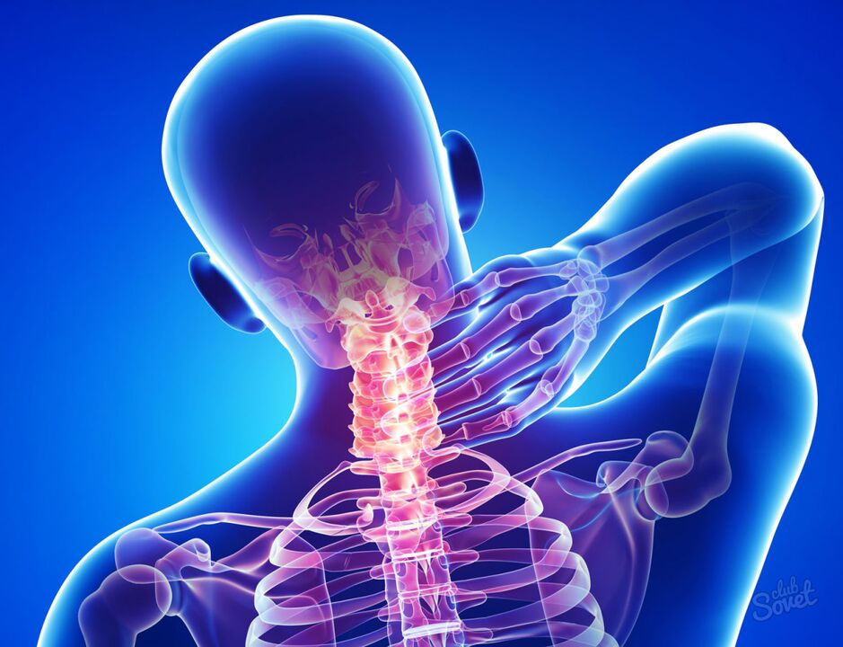 Osteochondroza cervicală
