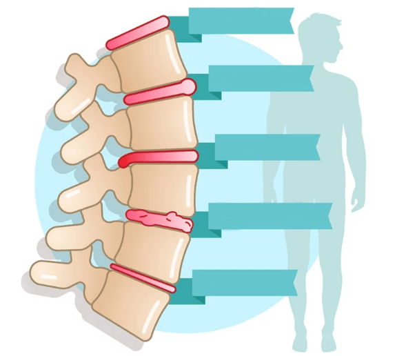 Gradul de boală a osteochondrozei toracice