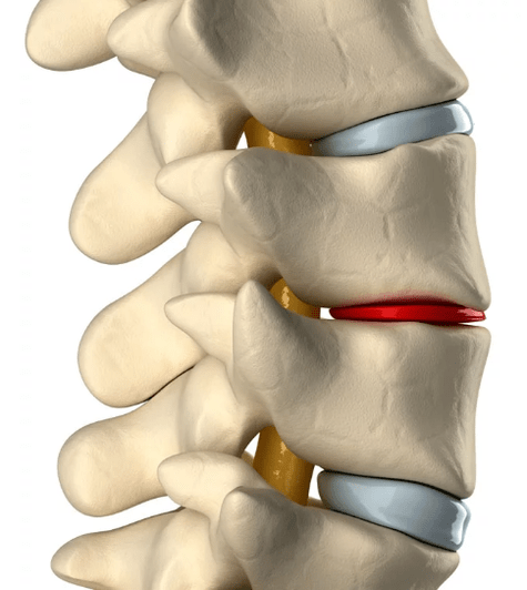 osteochondroza coloanei vertebrale toracice