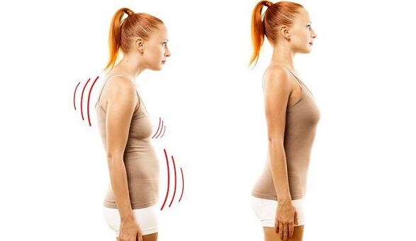 spate drept și postură proastă cu osteocondroză cervicală