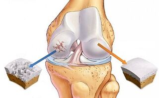 cartilaj sănătos și artroză a articulației genunchiului