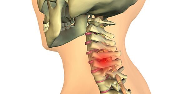 modificări ale coloanei vertebrale cu osteocondroză cervicală